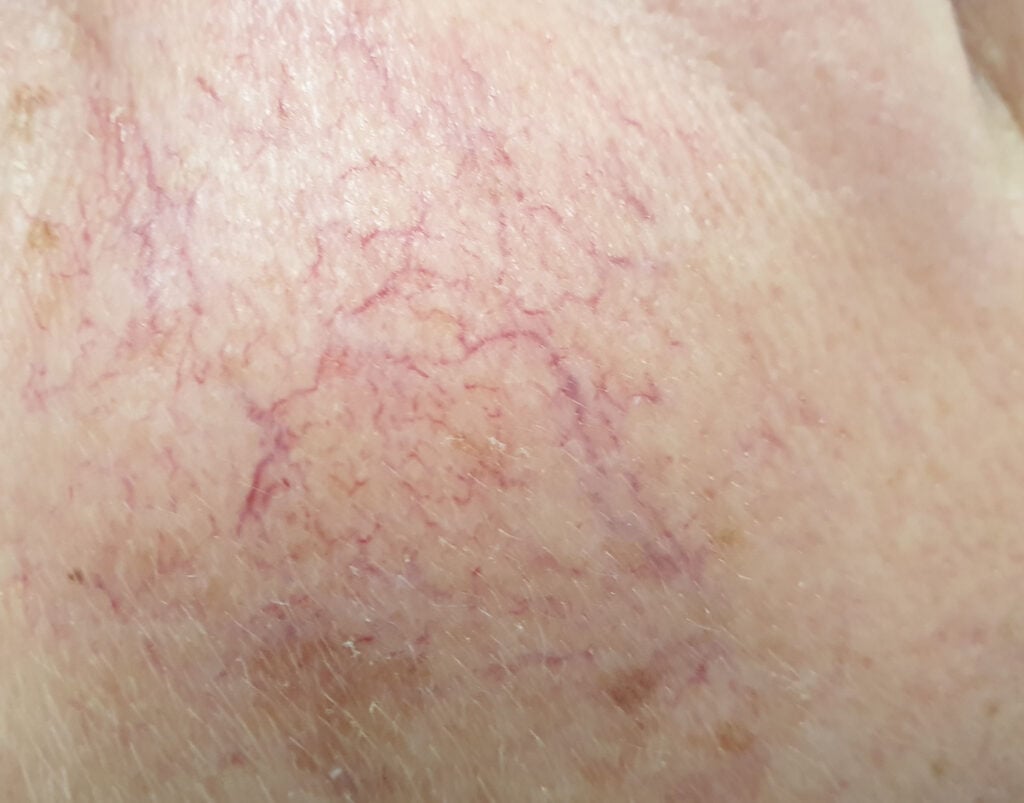 Diatheramy & Skin Tag Removal &raquo;